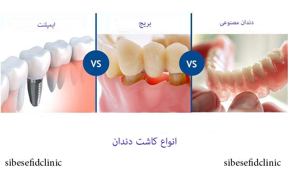 کاشت دندان، بهترین روش کاشت دندان
